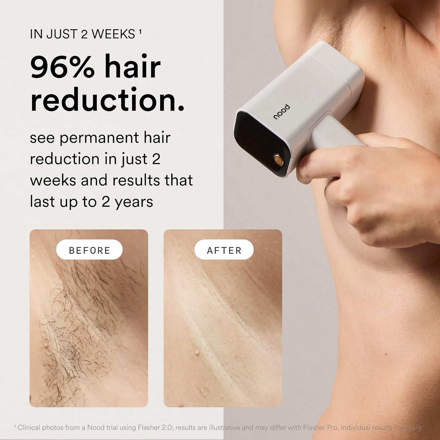 Nood™ NUEVO Flasher Pro \u2014 Dispositivo de depilación láser IPL...