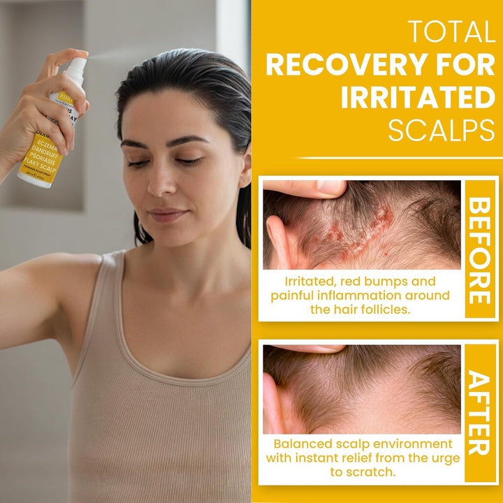 Psoriasis Scalp Spray | Tratamiento de psoriasis y caspa para infec...