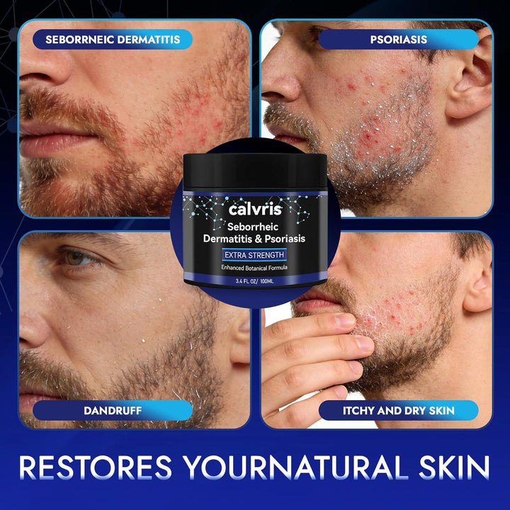 Calvris Crema extra fuerte para el cuero cabelludo, alivio de escam...