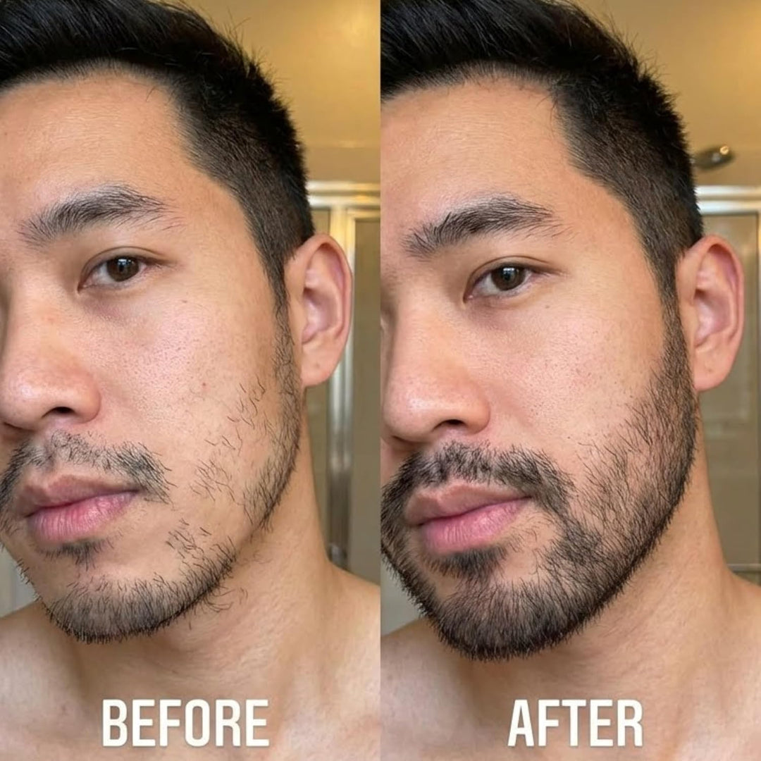 Innerbloom Minoxidil - Rodillo de crecimiento de barba con aceite d...