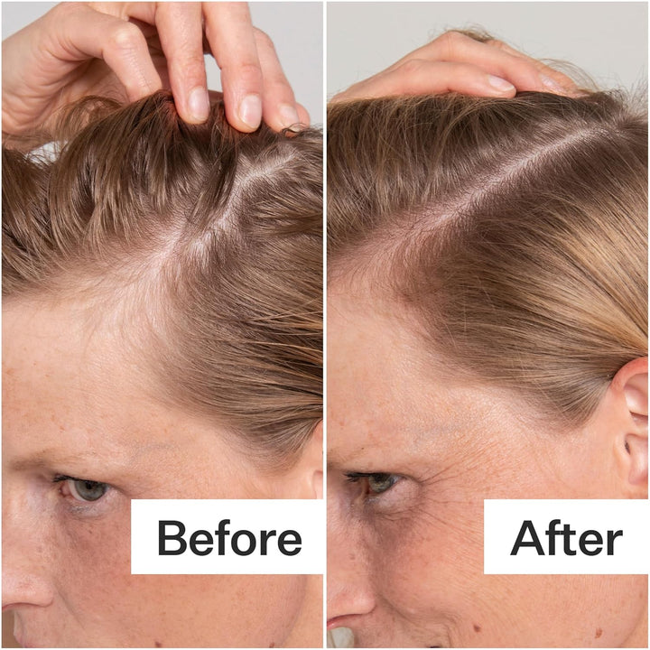 Act+ Acre Exfoliante de ácido salicílico procesado en frío | Para e...