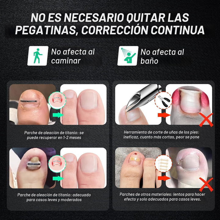Reieset Tratamiento de uñas encarnadas de aleación de titanio, herr...