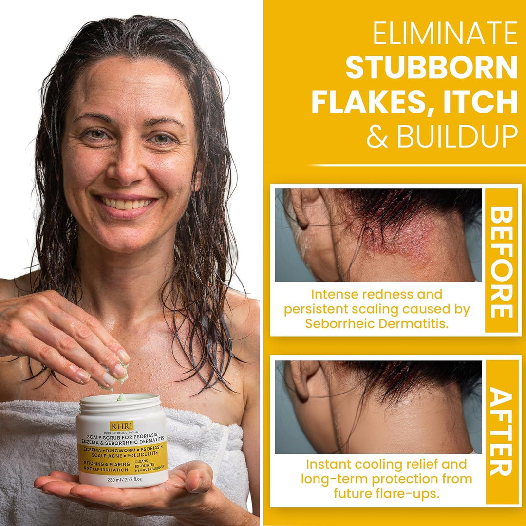 Exfoliante para el cuero cabelludo pre-champú antifúngico para psor...