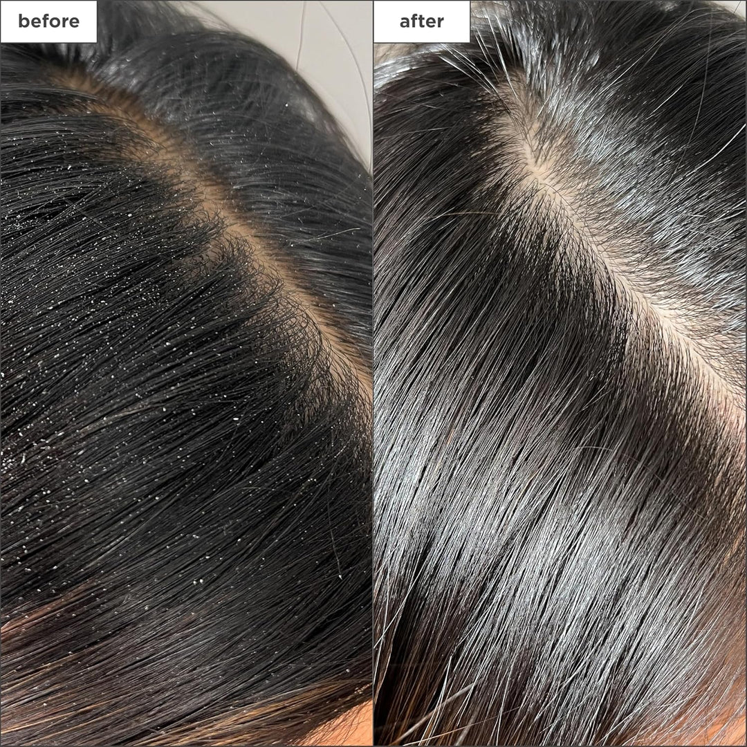 Briogeo Scalp Revival Charcoal + Tea Tree Buildup Detox Spray | Tra...