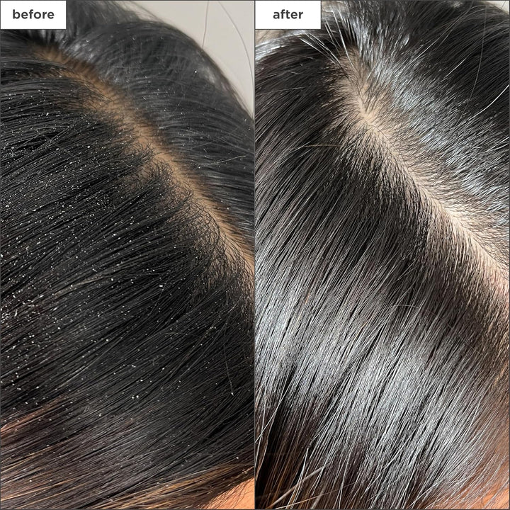 Briogeo Scalp Revival Charcoal + Tea Tree Buildup Detox Spray | Tra...