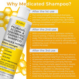 Champú antifúngico para psoriasis, eczema, champú para dermatitis s...